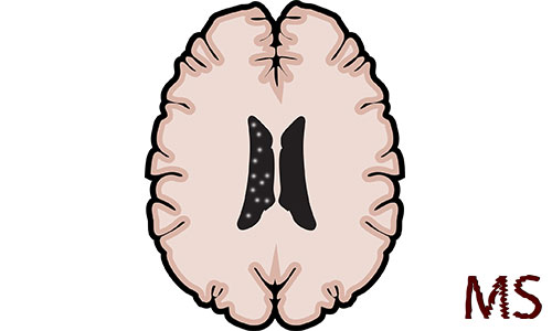 Multiple Sklerose entzündungsherde im Gehirn